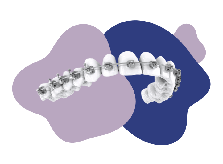 Traditional braces